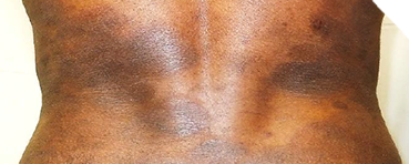 Photo of person with mycosis fungoides